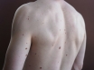 Most Australians will develop skin cancer